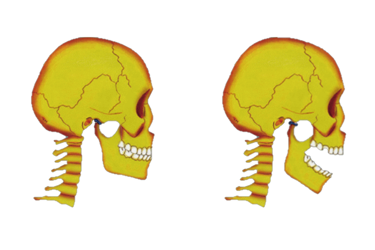 TMJ Disorders Jaw joint pain: TMJ pain can be caused by an inflammatory process of the synovial lining of the joint.