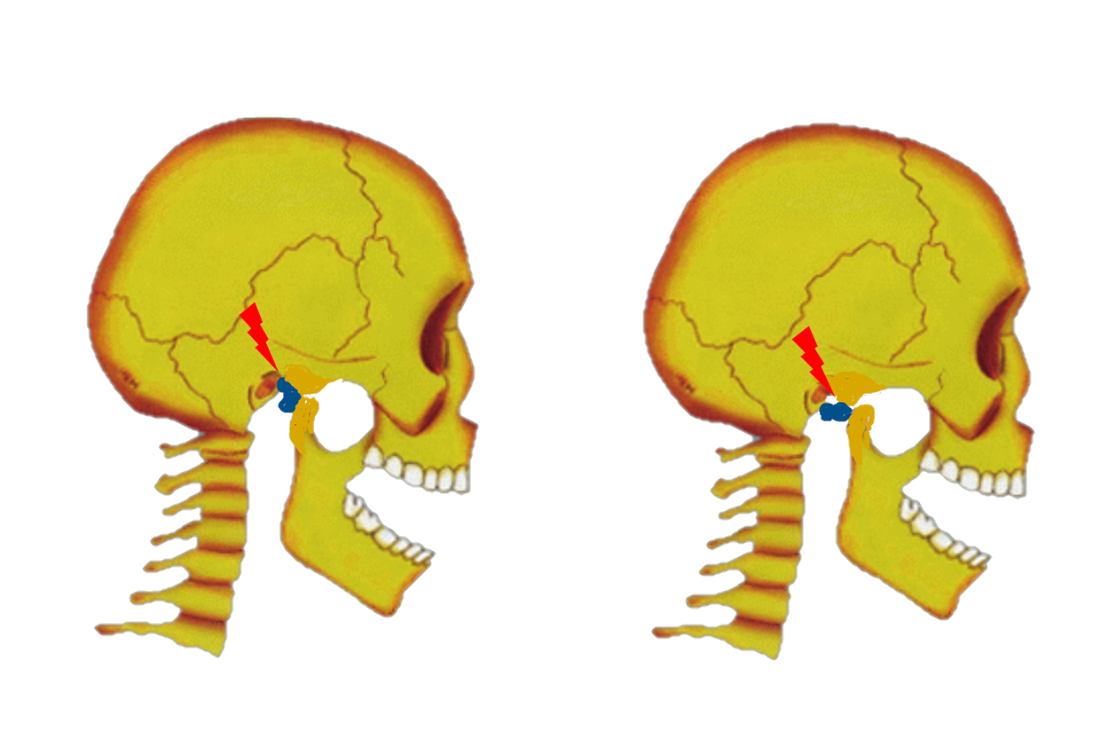 TMJ Jaw Pain Hypermobility Disorder: TMJ hypermobility disorders include 2 types of anterior condylar dislocations or “openlock”, related to stretching and/or tearing of the ligaments that stabilize the TMJs during opening and closing.